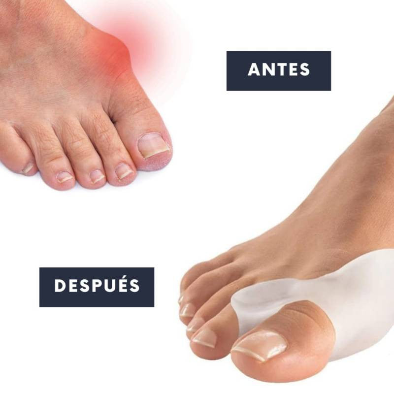 Corrector de Juanetes Hallux Valgus(™) de silicona, para el día y la noche.
